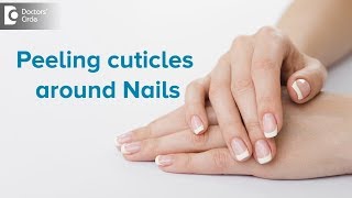 What to do for peeling cuticles around nails  Dr Rasya Dixit  Doctors Circle [upl. by Jen]