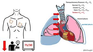 Thoracic Trauma [upl. by Acireit]