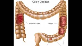 What is Bifidobacterium Infantis [upl. by Lledualc123]