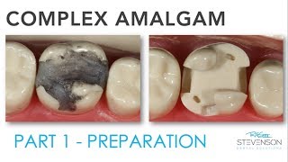 Complex Amalgam Preparation  Part 1 [upl. by Ydurt]