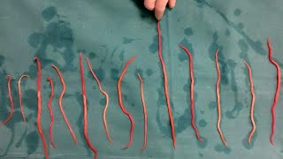 Doctors Remove 14 Roundworms From Woman [upl. by Nerta]