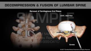 Decompression amp Fusion of Lumbar Spine [upl. by Ayom]