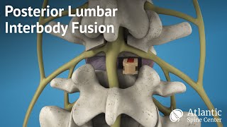 Posterior Lumbar Interbody Fusion PLIF [upl. by Jump129]