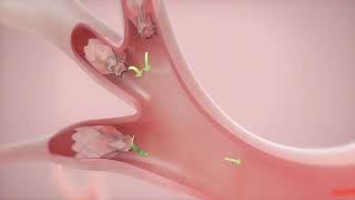 How It Works Zephyr Valve Treatment for COPD amp Emphysema [upl. by Brian]