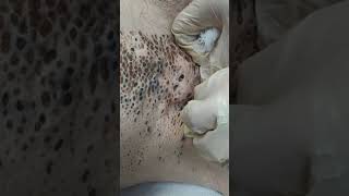 Nevus Comedonicus removal [upl. by Nolahs]