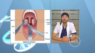 Bademcik İltihaplanması Belirtileri ve Tedavisi Bademcik Ameliyatı Nasıl Yapılır [upl. by Tohcnarf]