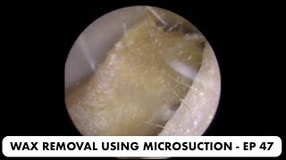 EAR WAX REMOVAL USING MICROSUCTION  EP 47 [upl. by Eleanora]