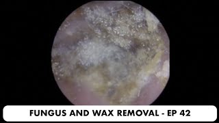 Ear Wax Removal for Hearing Aids  Auburn Medical Group [upl. by Hwu]