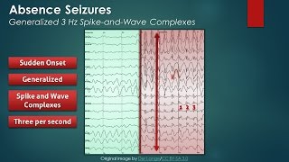 What are seizures [upl. by Wilkins]