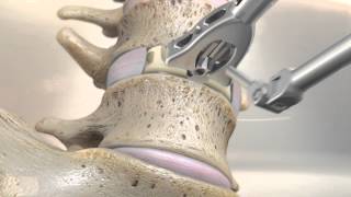 STALIF M™ MIDLINE II Surgical Technique Animation  Anterior Lumbar Interbody Fusion [upl. by Keeton]