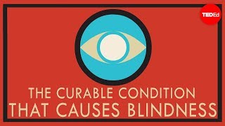 A curable condition that causes blindness  Andrew Bastawrous [upl. by Gorman]