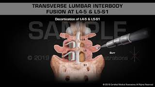 Transverse Lumbar Interbody Fusion at L45 amp L5S1  Medical Animation [upl. by Perlie338]